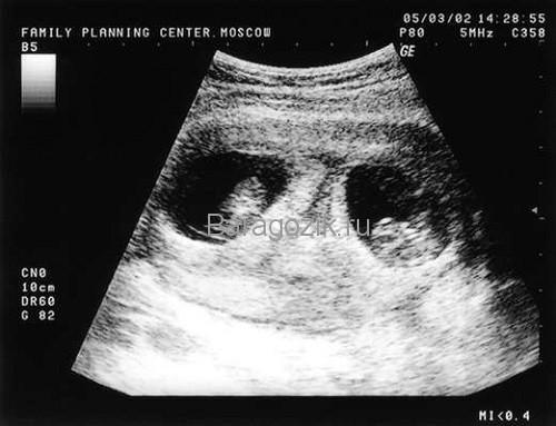 УЗИ - беременность двойней 7 акушерских недель
