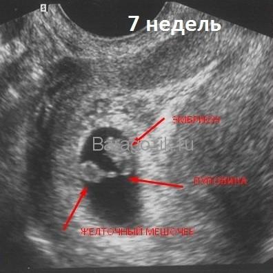 УЗИ - беременность 7 акушерских недель