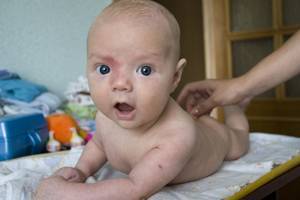 Гемангиома у новорожденных детей и грудничков