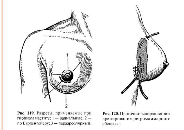 разрезы при гнойном мастите