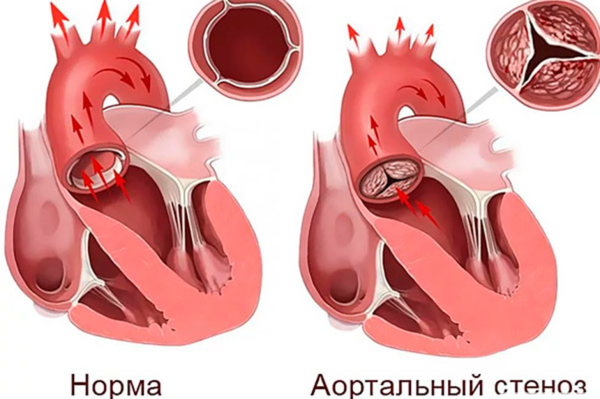 Артальный порок: аортальный стеноз