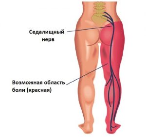 Область боли при ишиасе