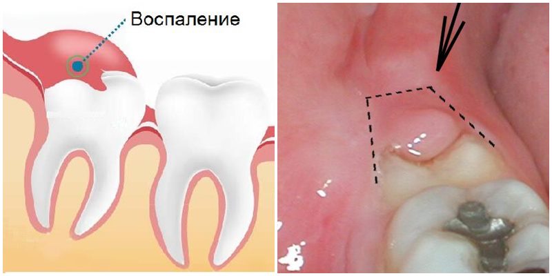 Воспаление капюшона зуба мудрости