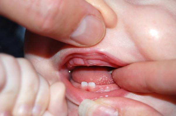 в каком порядке лезут зубы у ребенка бывают исключения