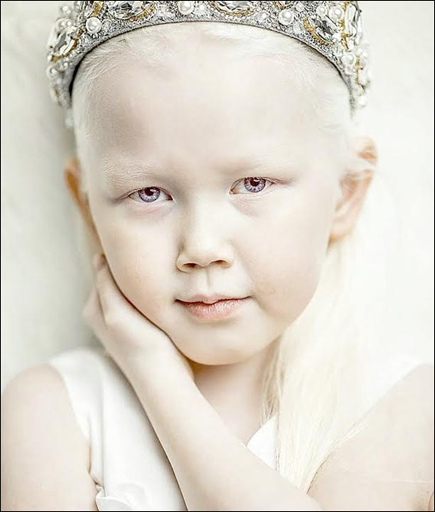 ребенок альбинос
