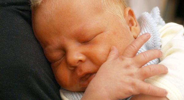 желтушка новорожденного