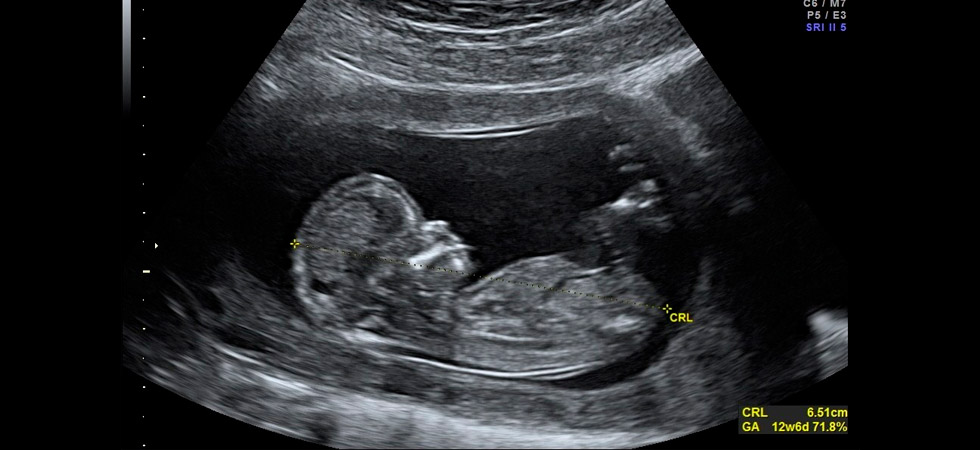УЗИ на 12 неделе беременности - фото
