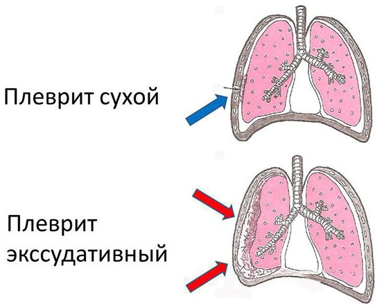 Пневмония. Симптомы, виды и лечение у взрослых. Препараты и народные средства