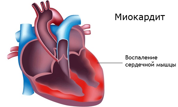 Вирус Коксаки у детей. Симптомы, чем лечить, инкубационный период