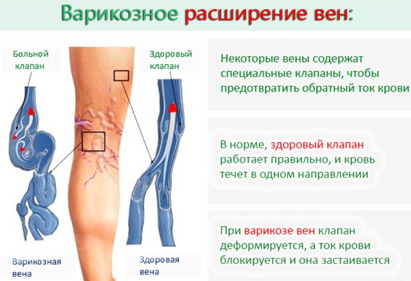 Как парить ноги с горчичным порошком при кашле, простуде, насморке