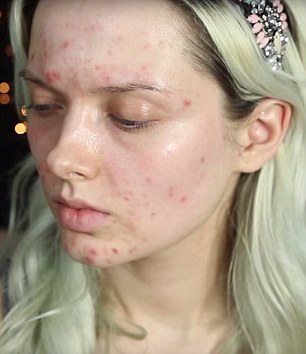 Em, pictured before her make-up regime, writes on her blog about her acne, 