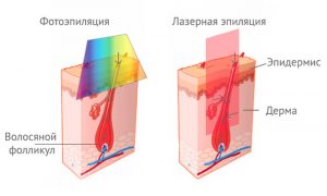 отличия фотоэпиляции и лазерной