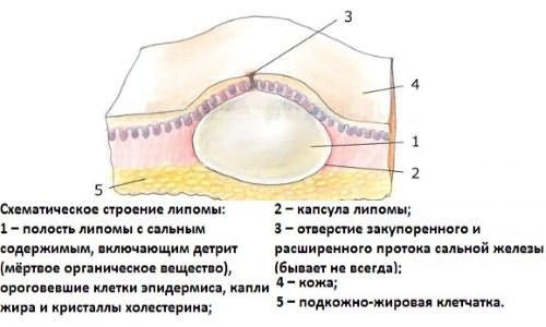  формирование жировика на носу и лице