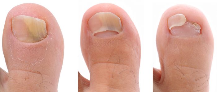 отслоение ногтя на большом пальце ноги