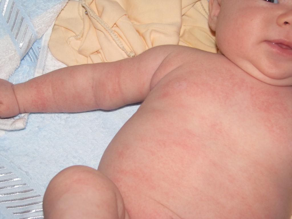 Сыпь на груди у ребенка может иметь инфекционную природу