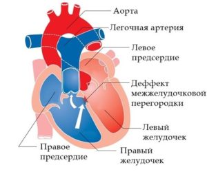 Аневризма сердца у ребенка