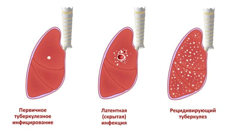 Стадии туберкулёза