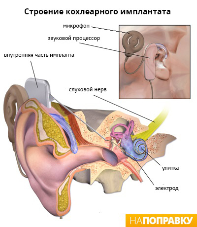 Строение кохлеарного имплантата