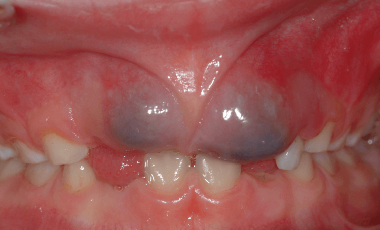 Синяя десна при прорезывании зубов у грудничков: фото