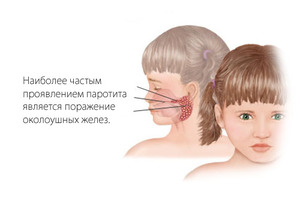 Симптомы свинки - как определить заболевание