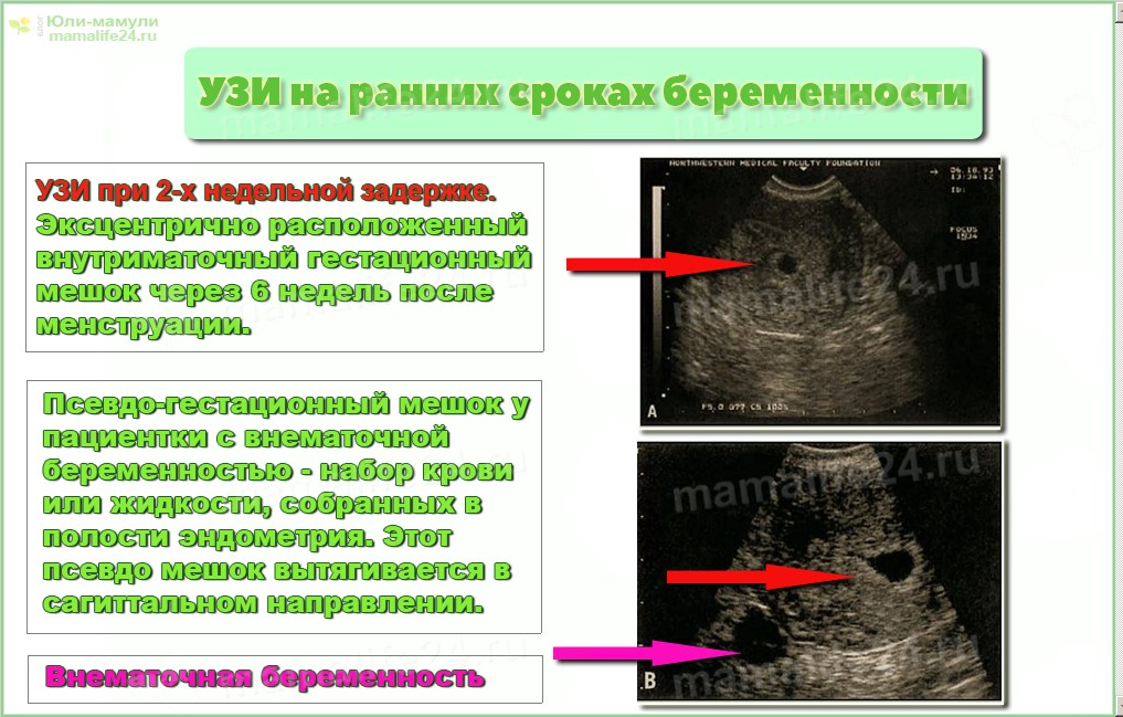 внематочная беременность на узи на ранних сроках