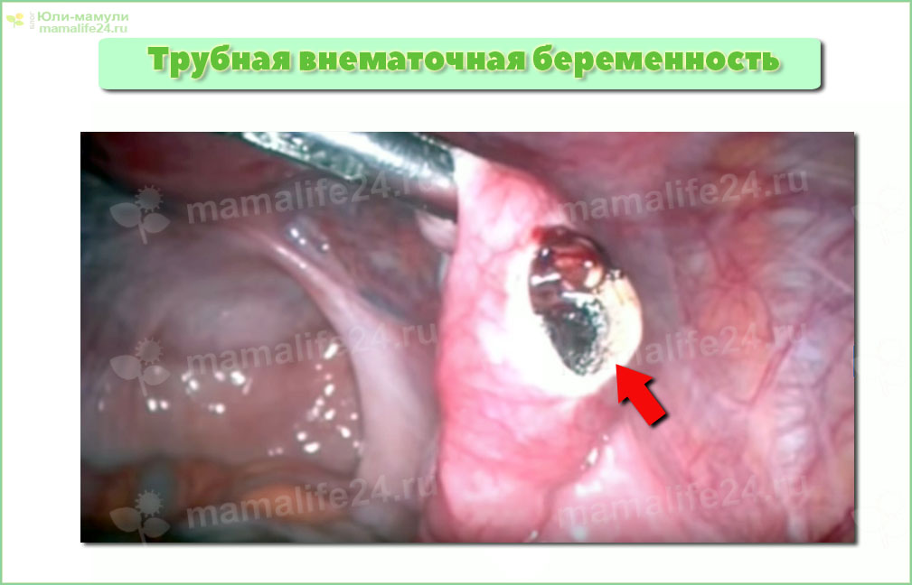 Трубная эктопическая (внематочная) беременность