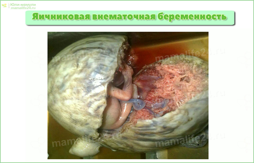 Яичниковая внематочная беременность фото