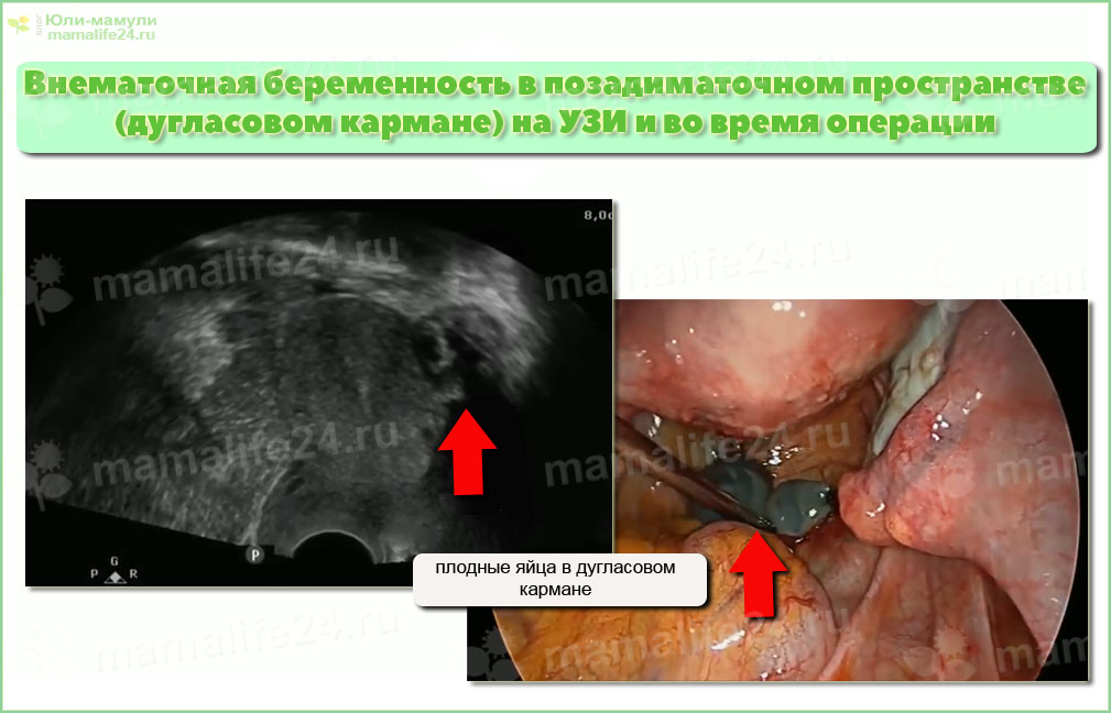 Внематочная беременность в позадиматочном пространстве (дугласовом кармане) на УЗИ и во время операции