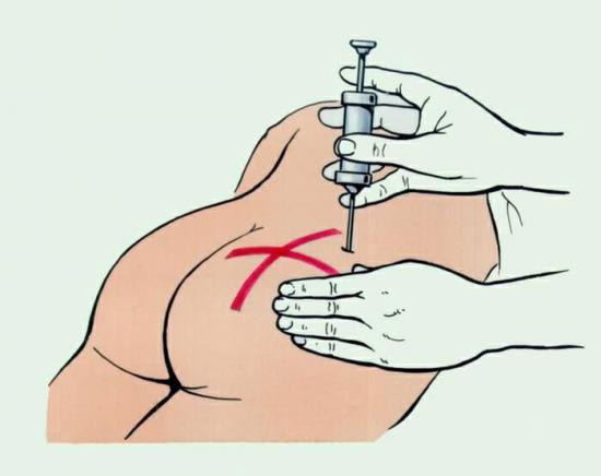 Правильный выбор места для укола