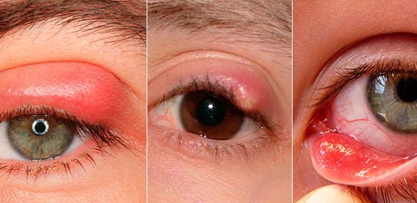 Ячмень на глазу – симптомы
