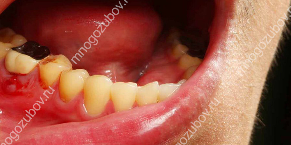 Воспеление десен при заболевании зубов