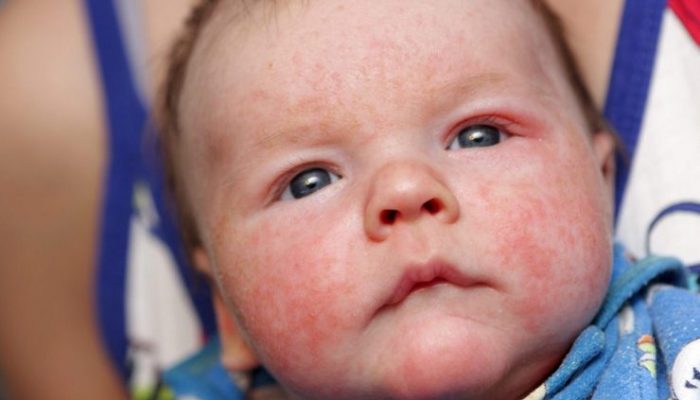 Что означают красные пятна на лице у ребенка? Основные причины симптома у новорожденного и подростков