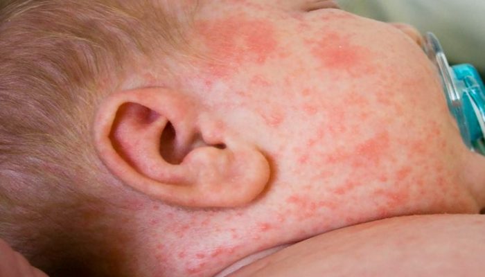 Что означают красные пятна на лице у ребенка? Основные причины симптома у новорожденного и подростков