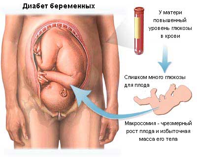 Диабет у беременных - избыточная масса плода