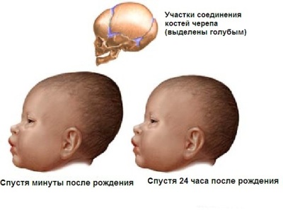 Форма головы новорожденного изменяется благодаря родничкам и податливости швов