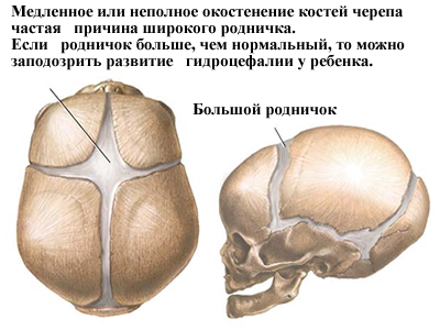 Причины большого родничка - различные заболевания