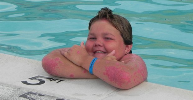 Полный ребенок с псориазом на руках улыбается в басейне