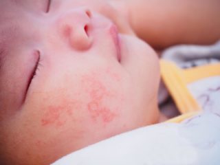 Небольшая сыпь - проявление аллергии на хлорофиллипт
