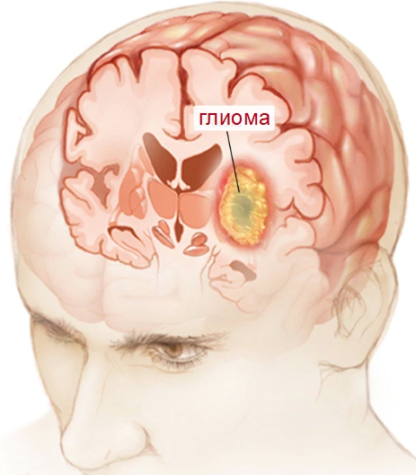 Глиома в головном мозге
