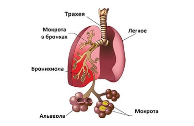 Застойная пневмония