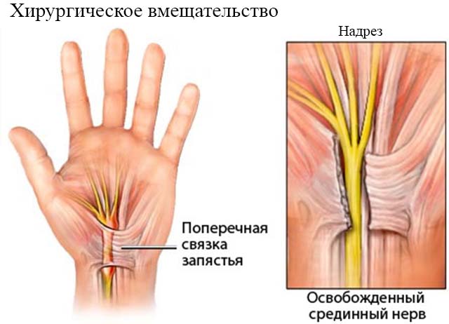 Хирургическое вмешательство на запястье