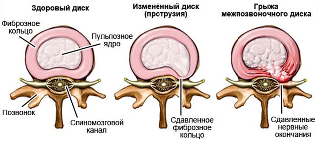 Межпозвонковые диски