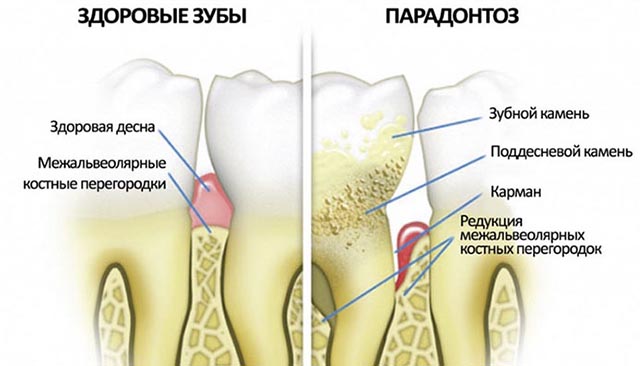 Пародонтоз
