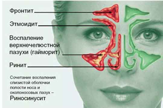 Аллергический гнойный вазомоторный риносинусит и прочие виды заболевания