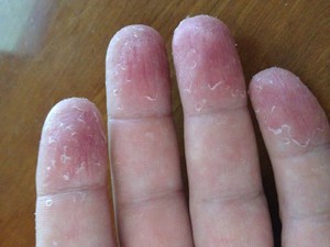 Причины шелушения кожи рук