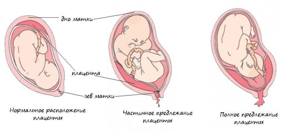 Картинка показывающая причины возникновения предлежания плаценты