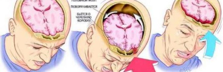 Можно ли выжить после отека мозга