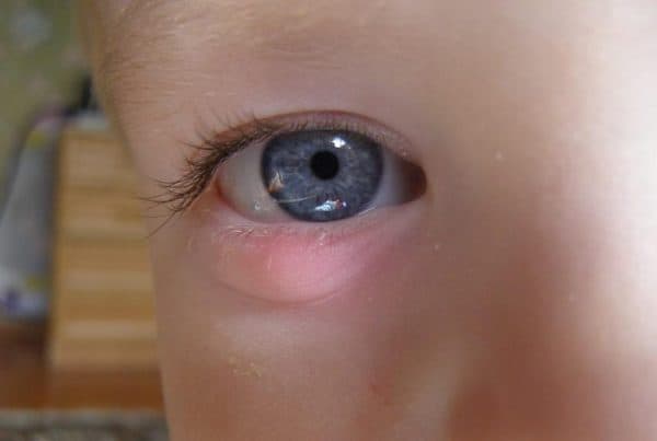 Внутренний ячмень на глазу у ребенка