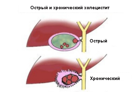 Острый и хронический холецистит