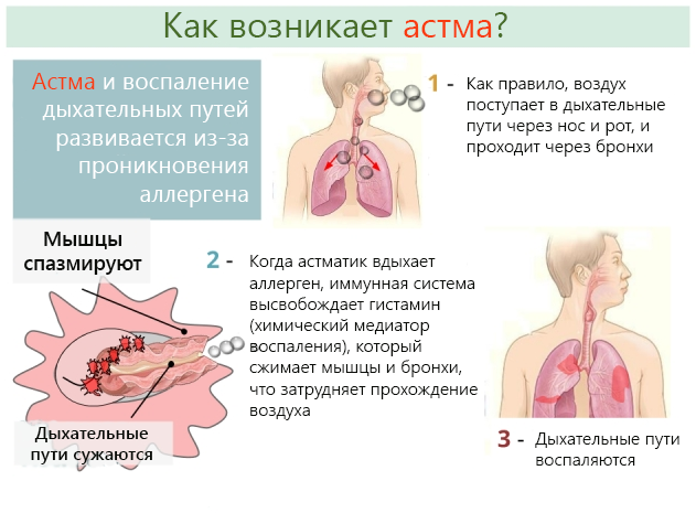 Как развивается бронхиальная астма